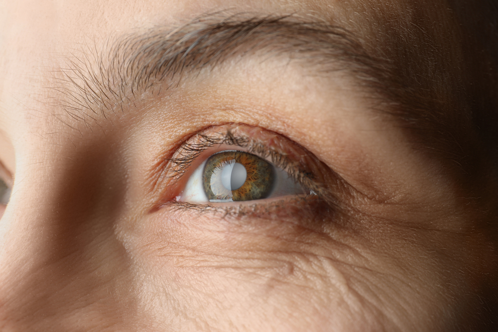 Glaucoma: fique de olho nos cuidados com a doença