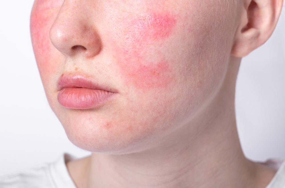 Alergia de pele exige cuidados durante o calor