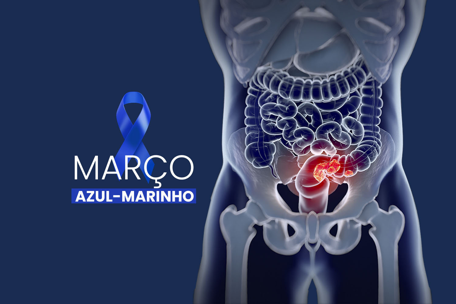 Março Azul-Marinho faz alerta sobre o câncer colorretal